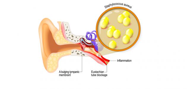 أسباب التهاب الأذن الوسطى