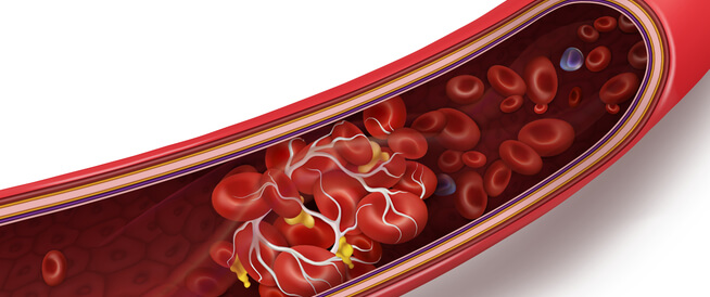 أسباب الجلطة الدموية تعرف عليها