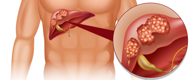 أسباب سرطان الكبد النّقيلي ومراحل تطوره
