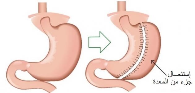 أضرار عملية تكميم المعدة