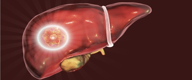 أعراض أورام الكبد الحميدة وأبرز المعلومات عنهم