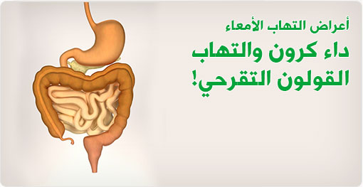 أعراض التهاب الأمعاء، داء كرون والتهاب القولون التقرحي