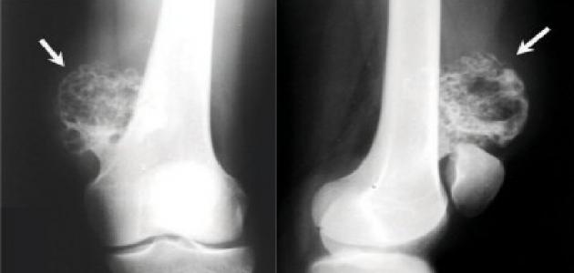 أعراض سرطان العظام عند الأطفال