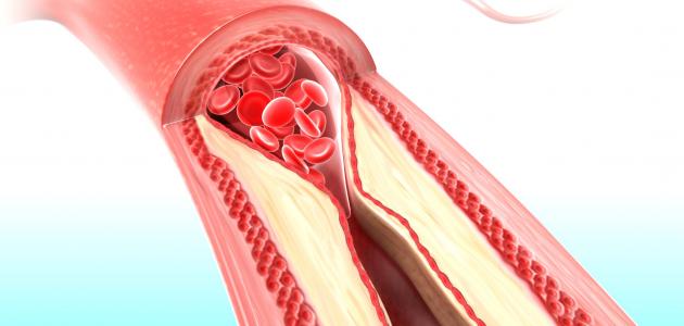 أعراض ضيق الأوعية الدموية