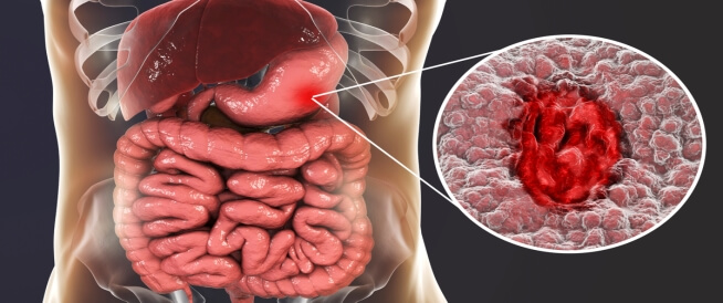 أعراض قرحة المعدة والقولون تعرف عليها