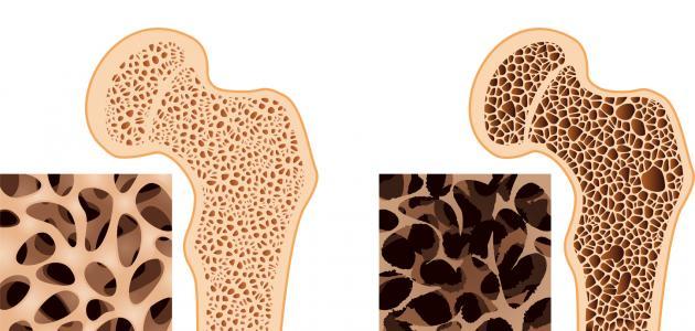 أعراض هشاشة العظام عند النساء