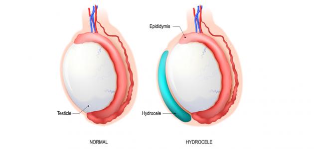 أمراض الخصيتين عند الرجل