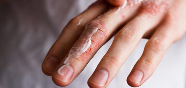 أنواع حساسية الجلد