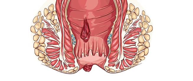 أهم المعلومات حول البواسير