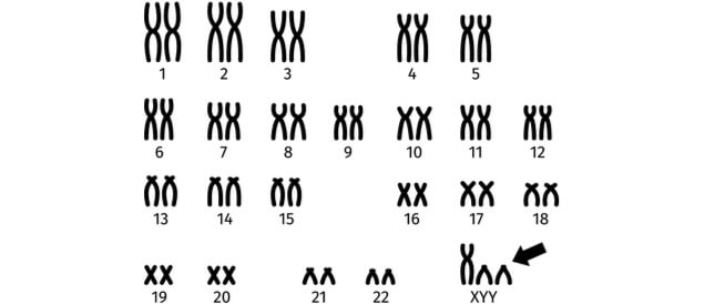 أهم المعلومات عن متلازمة XYY