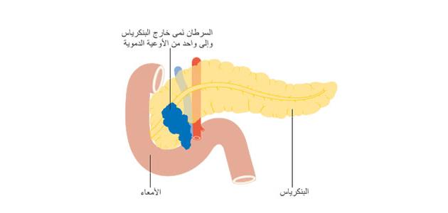 أورام البنكرياس وأعراضه