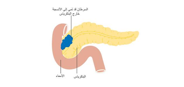 أورام البنكرياس