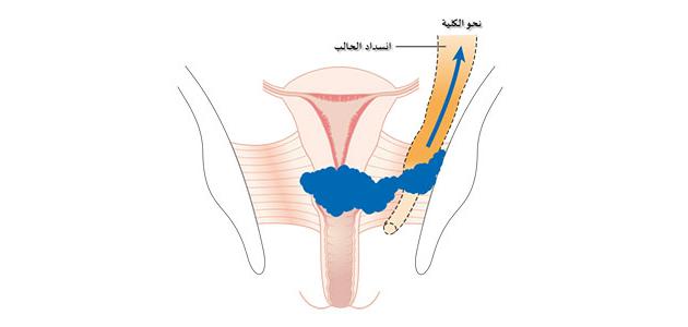 أورام الرحم الخبيثة