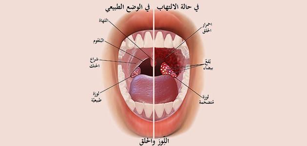 أورام الغدد اللعابية