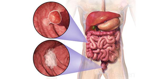 أورام المستقيم