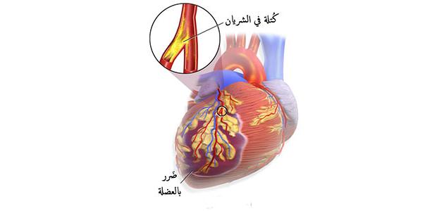 ارتجاع صمام القلب