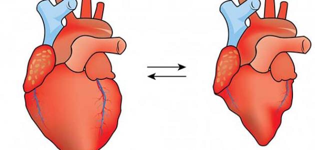 ارتخاء صمام القلب وكيفية علاجه