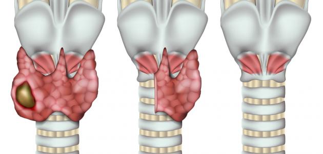 استئصال الغدة الدرقية