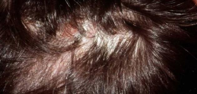 اعراض التهاب بصيلات الشعر