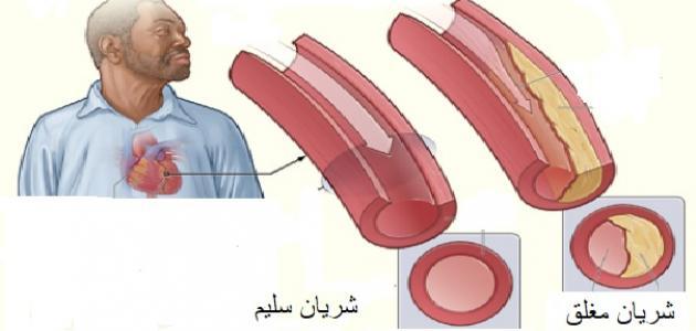 اعراض تصلب الشراين