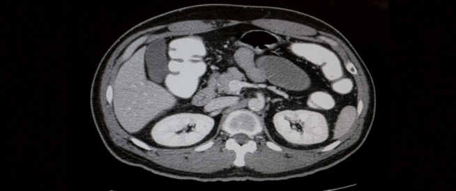 الأشعة المقطعية للبطن معلومات تهمك