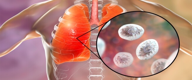 التهاب الرئة الفطري معلومات تهمك