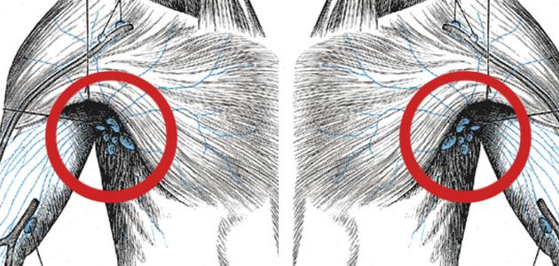 التهاب الغدد اللمفاوية في الإبط