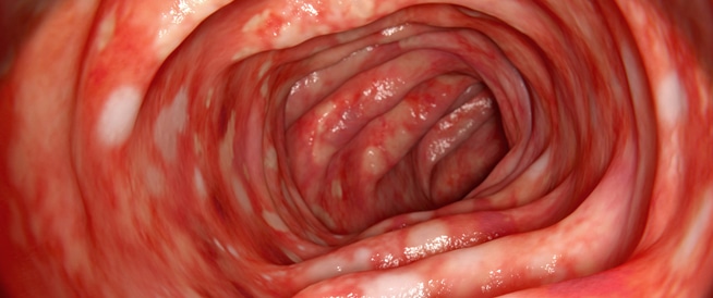 التهاب القولون الأيسر تعرف على الأعراض والأسباب والعلاج