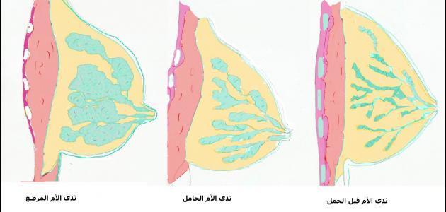 التهاب غدد الحليب