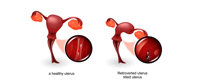 الرحم المقلوب ما هو وهل يؤثر على الحمل؟
