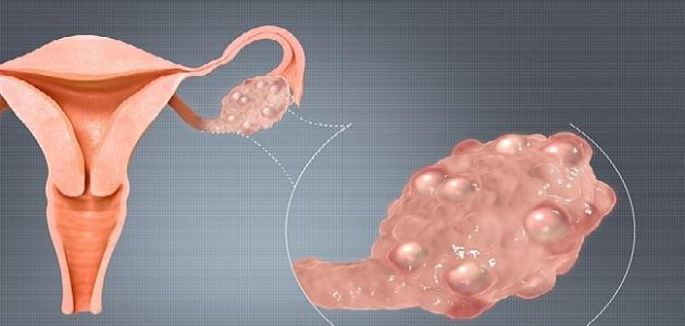 السمنة ومتلازمة تكيس المبايض