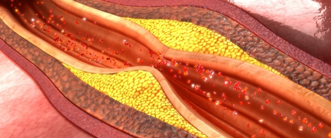 الشرايين التاجية ومرض الشريان التاجي إليك أبرز المعلومات