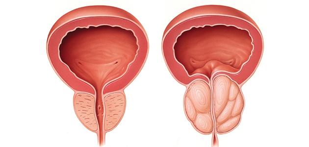 الفرق بين تضخم البروستاتا الحميد والخبيث