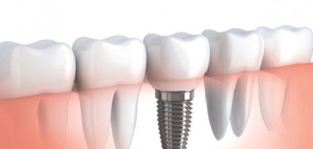 الفرق بين زراعة الأسنان وتركيب الأسنان