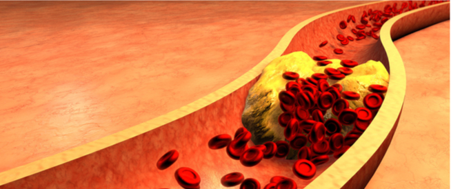 الكوليسترول الوراثي اضطراب جيني يهمك أن تعرف عنه