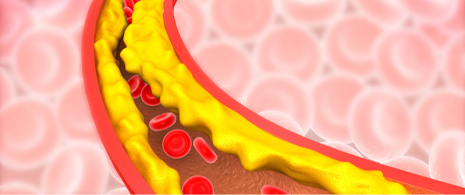 الوقاية من تصلب الشرايين