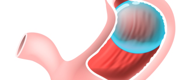 بالون المعدة كل ما عليك معرفته
