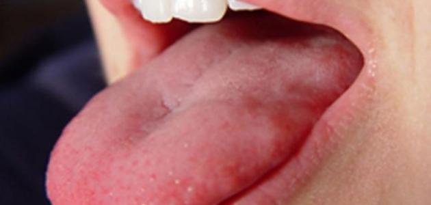 تأثير الزهري على الفم