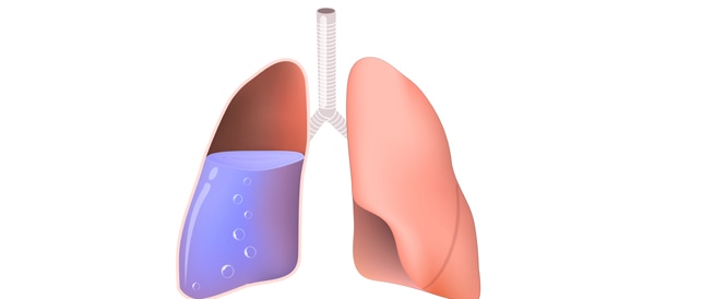 تجمع الماء في الرئة دليلك الكامل