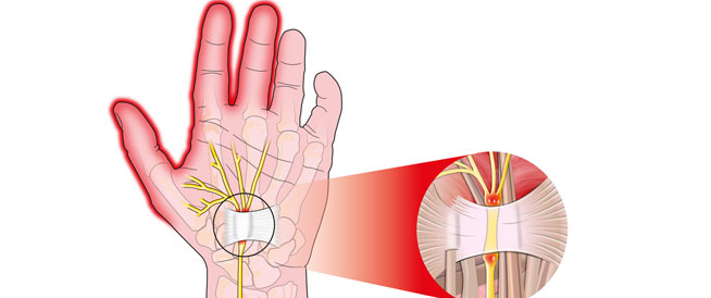 تصلب الأعصاب أسباب وأعراض وعلاجات