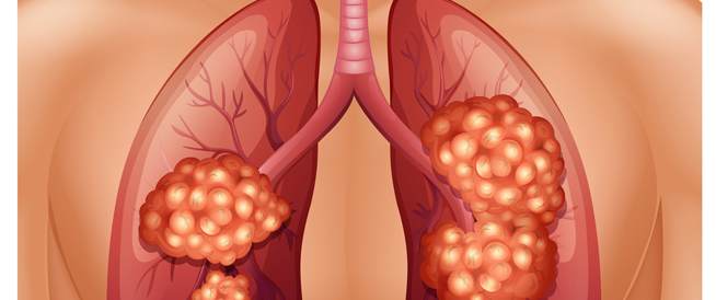 تعرف على سرطان الرئة المرحلة الثالثة