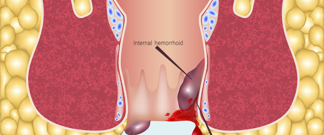 تعرفي على أعراض البواسير بعد الولادة