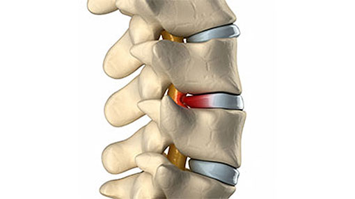 تعرّف على علاج الانزلاق الغضروفي