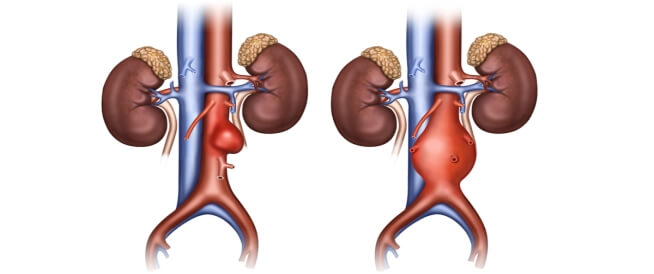 تمدد الشريان الأورطي البطني الأسباب والتشخيص