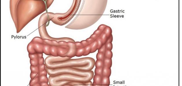 جراحة تحويل مسار المعدة