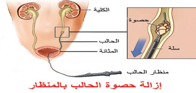 حصوة في الحالب