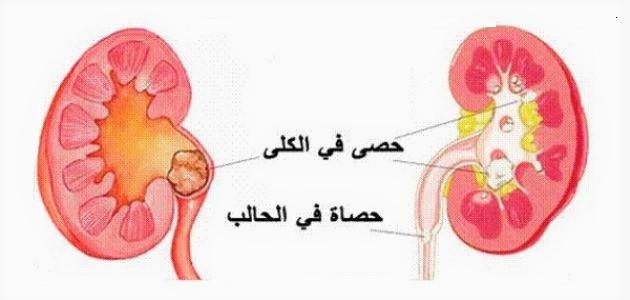 حصى الكلى أسبابها وعلاجها