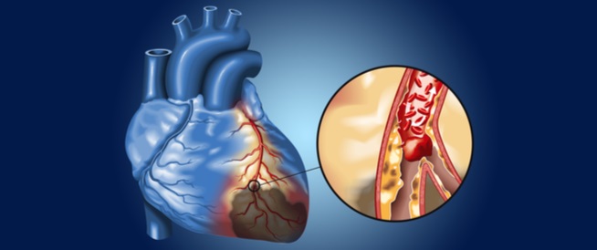 خطورة انسداد شرايين القلب