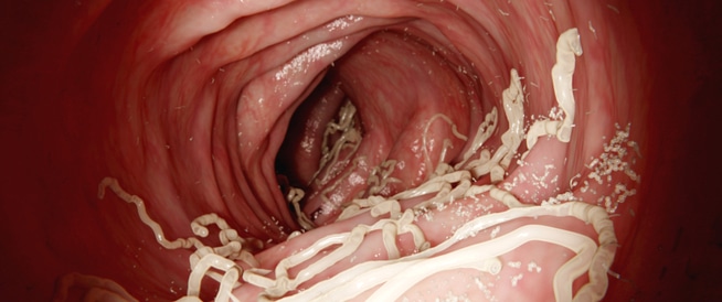 ديدان الأمعاء كل ما تحتاج معرفته عنها