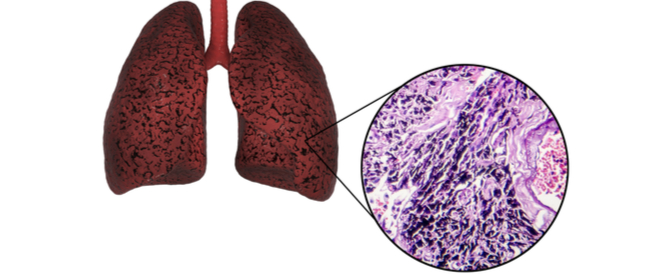 رئة المدخن أمراض وحالات صحية يجب أن تتعرف عليها